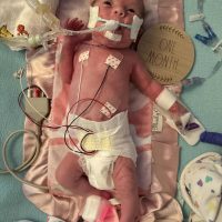 NICU micro-premie mom oversupply